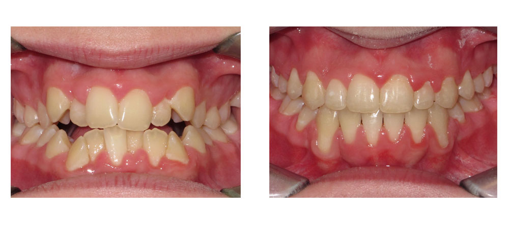 overbite before and after
